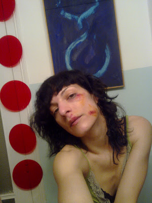 Roser Amills Accidente Bicicleta Golpes En La Cara Mercromina Cicatrices