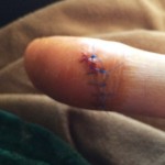 Roser Amills Accidente Dedo