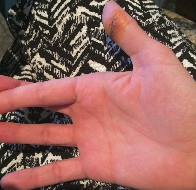 Roser Amills Dedo Accidente