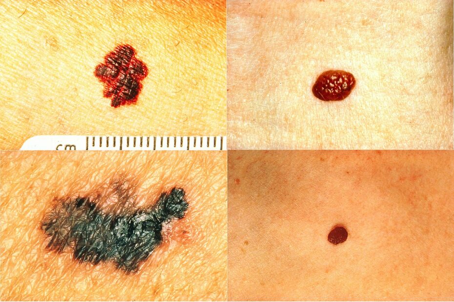 Comparación entre lunares normales y melanomas según la regla ABCD